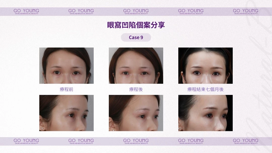 PROSTROLANE Natural B 膠原肽