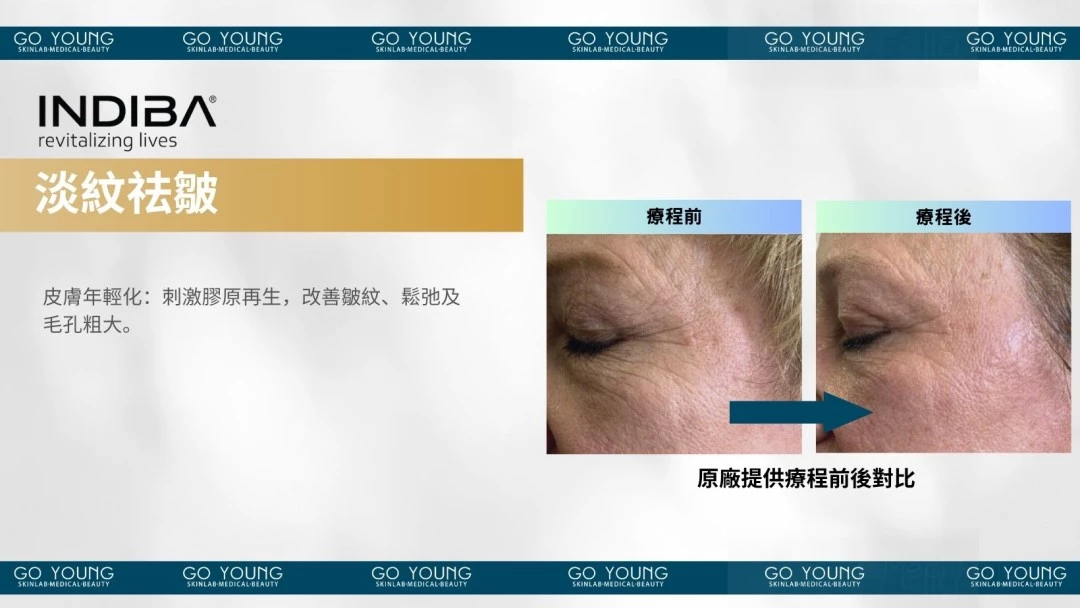 治療師主理|INDIBA® Premium NS