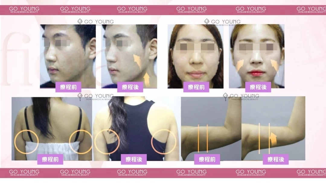 Fiola S 消脂針 (face & body)
