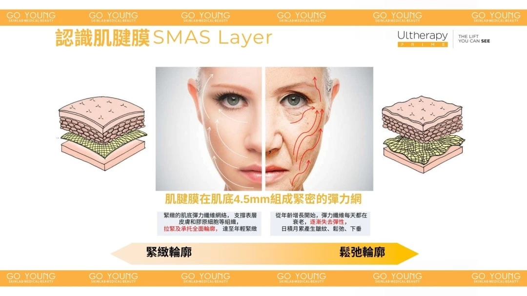 醫生主理 | Ultherapy PRIME® HIFU 二代 超聲刀療程