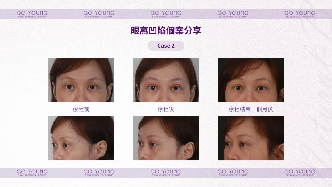 PROSTROLANE Natural B 膠原肽