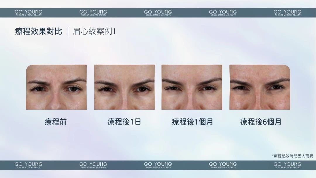 Relfydess®珍珠小黑盒(瘦面 1ml)