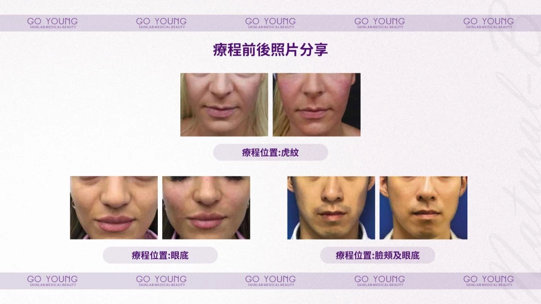 PROSTROLANE Natural B 膠原肽