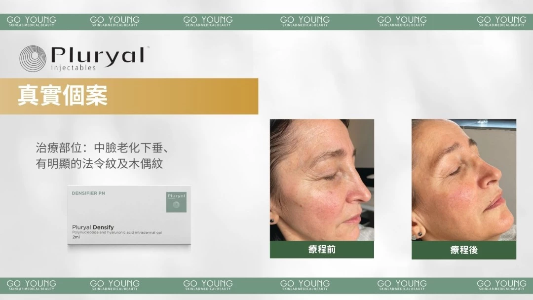 PLURYAL® DENSIFY 濾鏡針-緻柔針