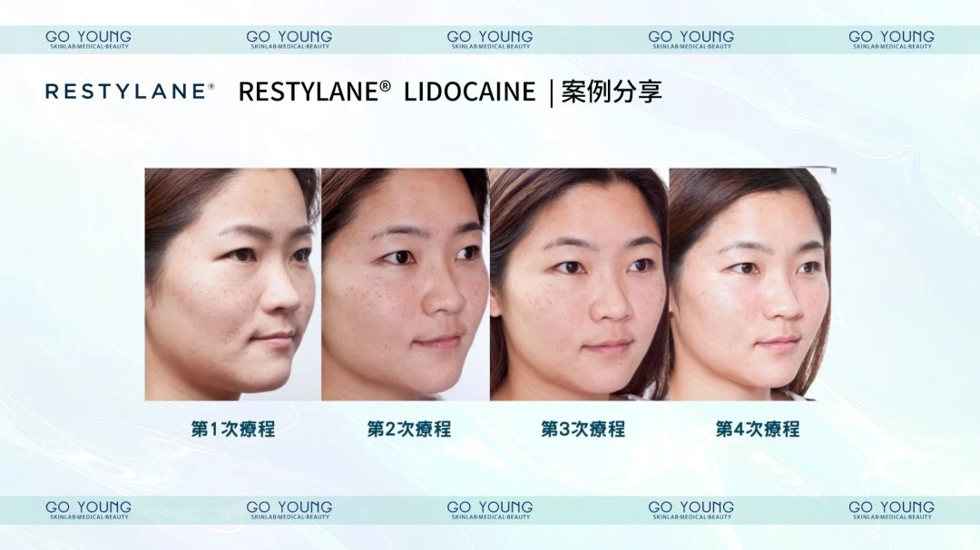 RESTYLANE® with Lidocaine