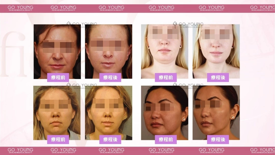 Fiola S 消脂針 (face & body)