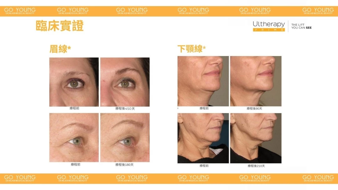 醫生主理 | Ultherapy PRIME® HIFU 二代 超聲刀療程