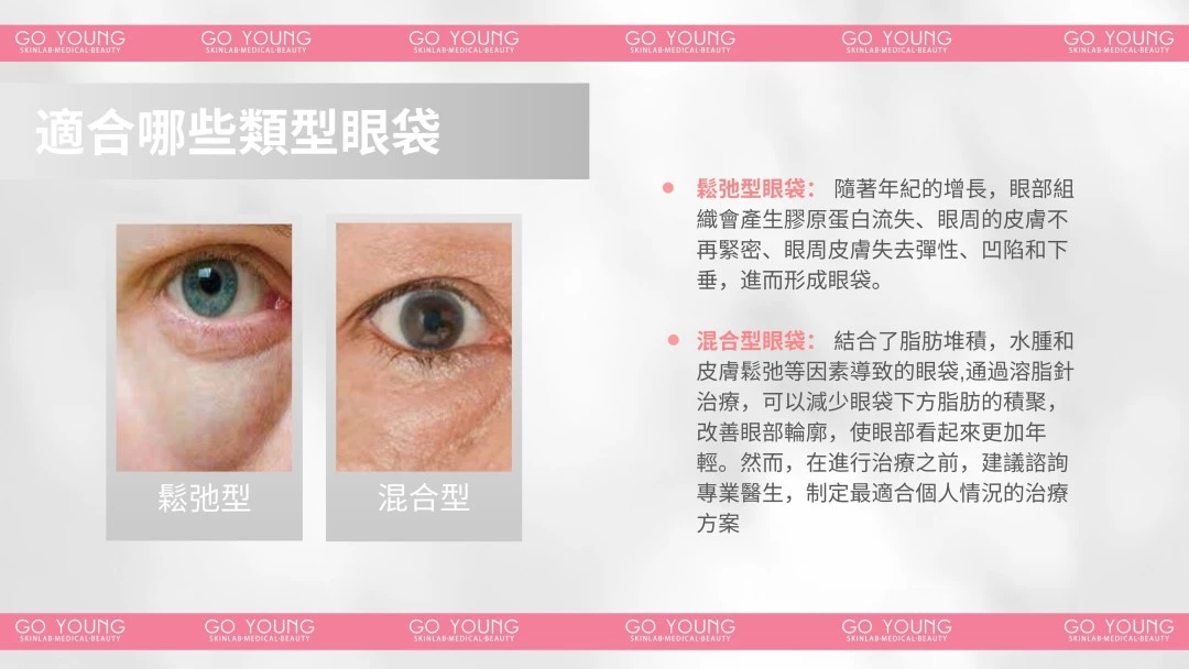 Fiola 眼袋針