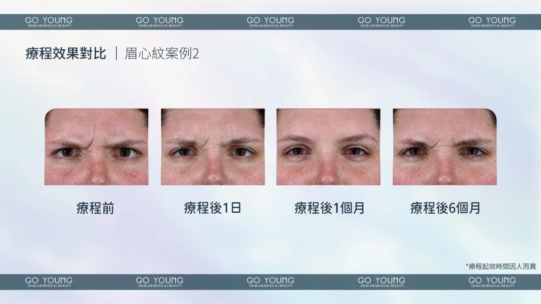 Relfydess®珍珠小黑盒(瘦面 1ml)