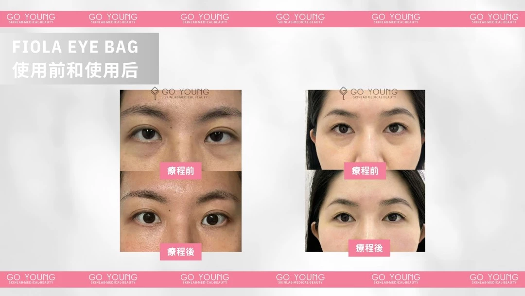 Fiola 眼袋針