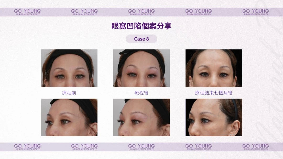 PROSTROLANE Natural B 膠原肽