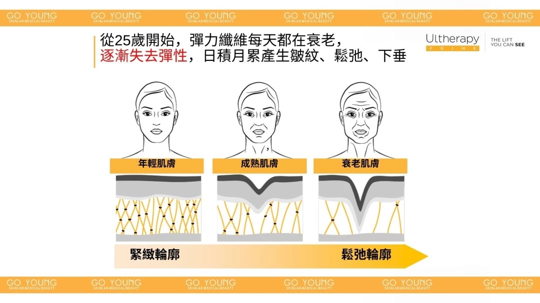 醫生主理 | Ultherapy PRIME® HIFU 二代 超聲刀療程