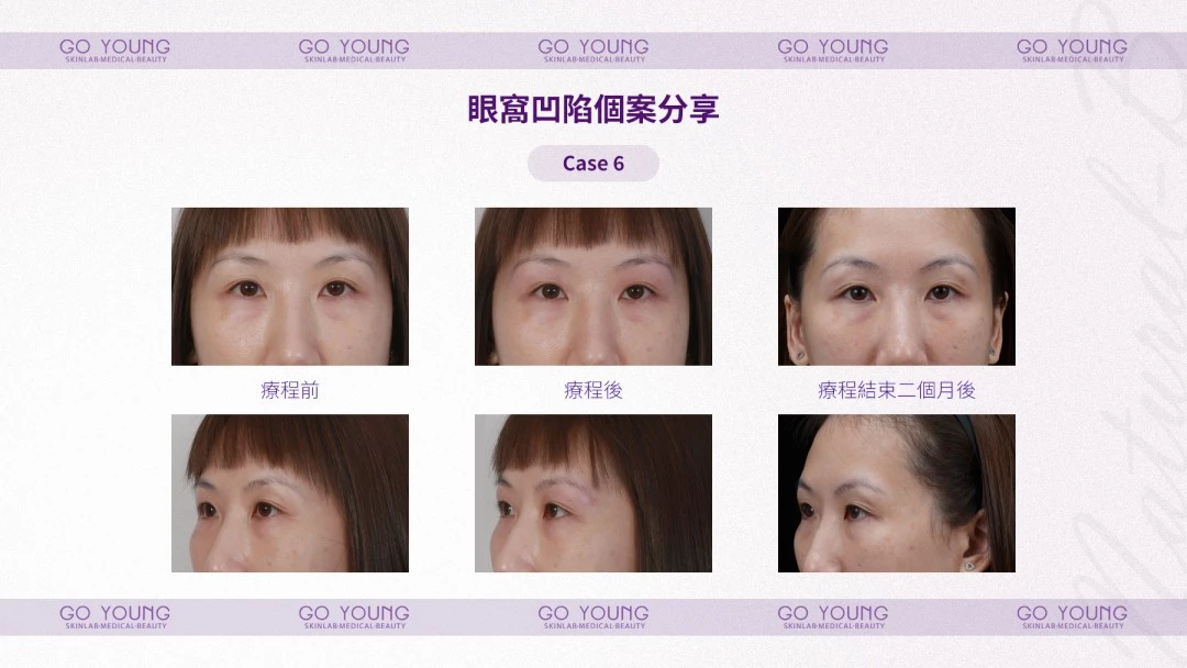 PROSTROLANE Natural B 膠原肽