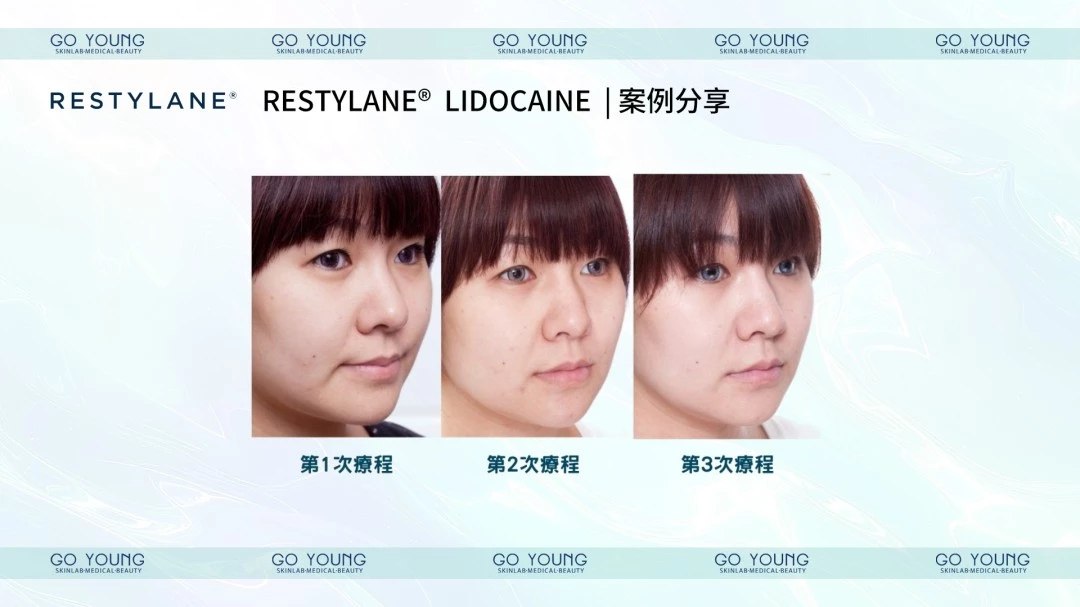 RESTYLANE® with Lidocaine