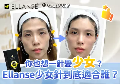 Ellanse少女針：適合哪些人群的美麗選擇 - Go Young