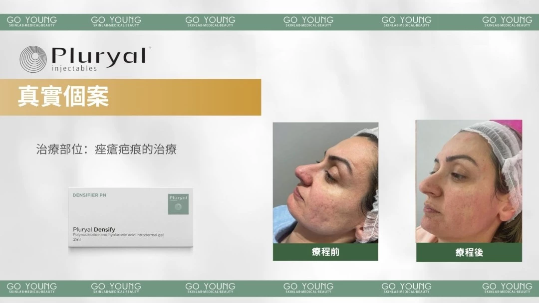PLURYAL® DENSIFY 濾鏡針-緻柔針