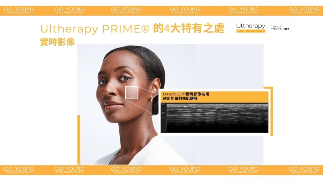 醫生主理 | Ultherapy PRIME® HIFU 二代 超聲刀療程