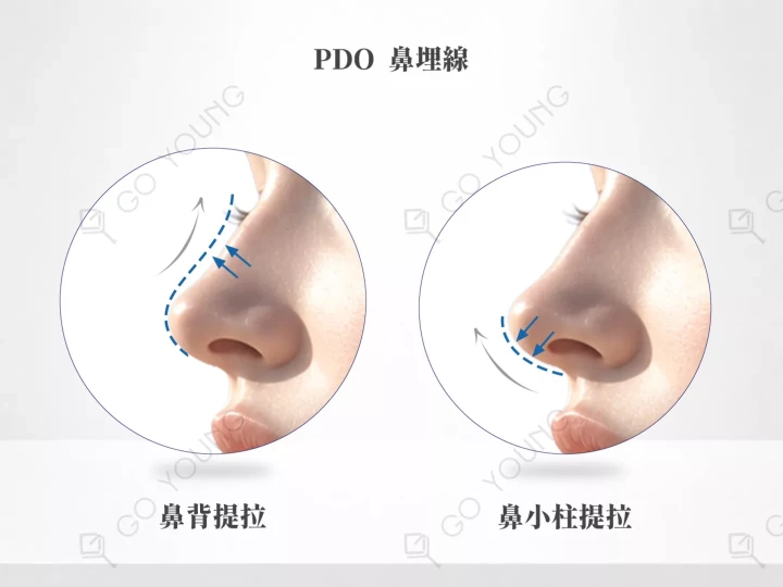 PDO 鼻埋線