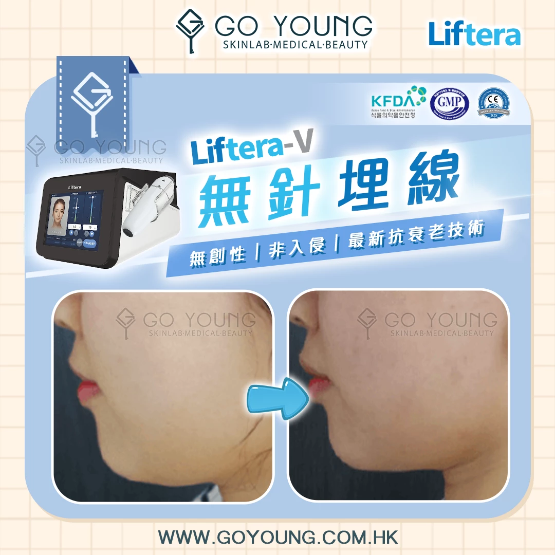 Liftera-V Lift 無針埋線療程