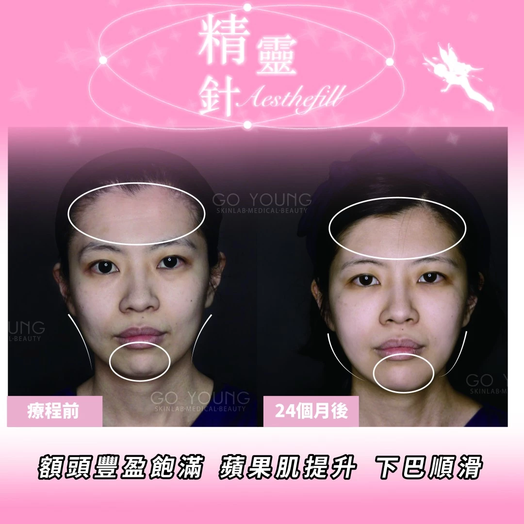AestheFill 精靈針