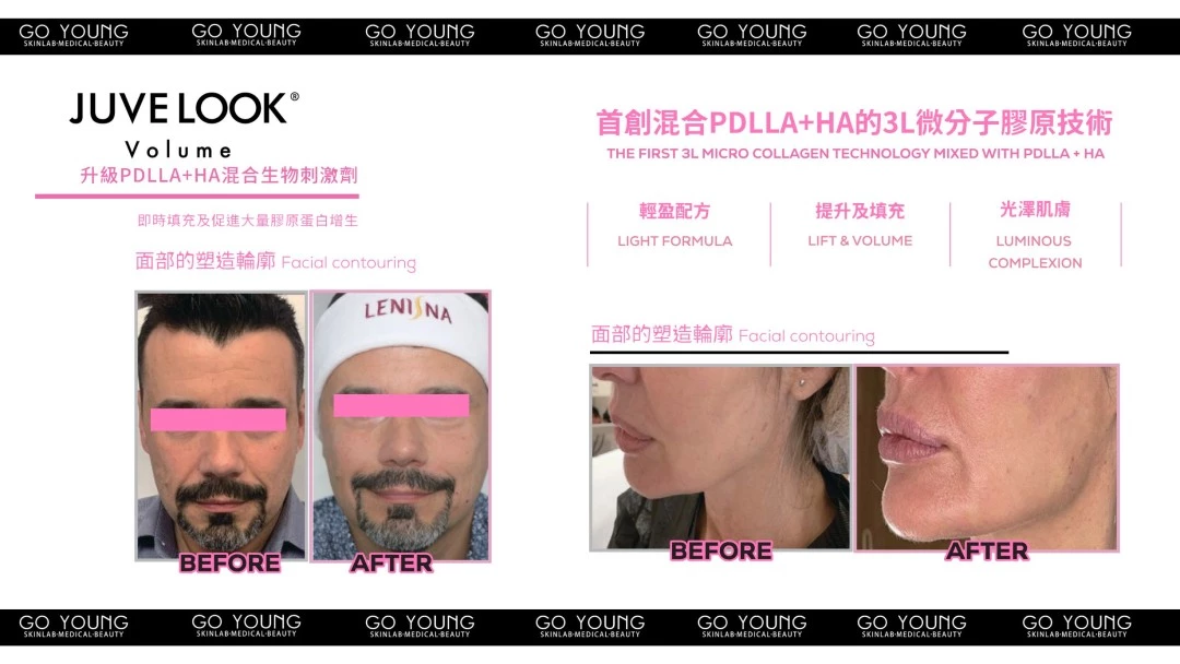 JUVELOOK Volume 塑顏針