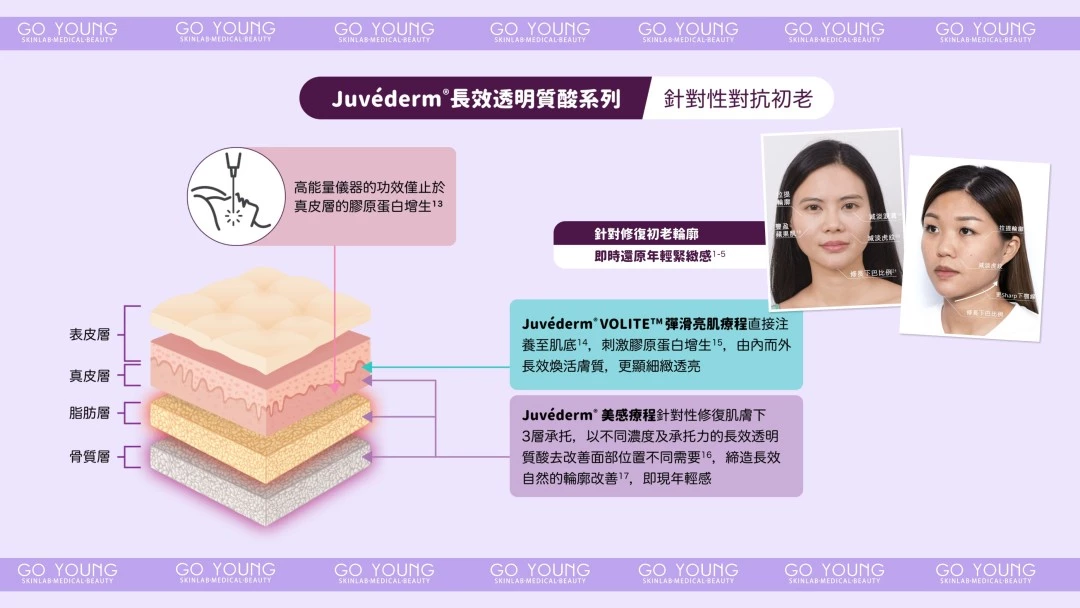JUVÉDERM® VOLIFT（緹顏）