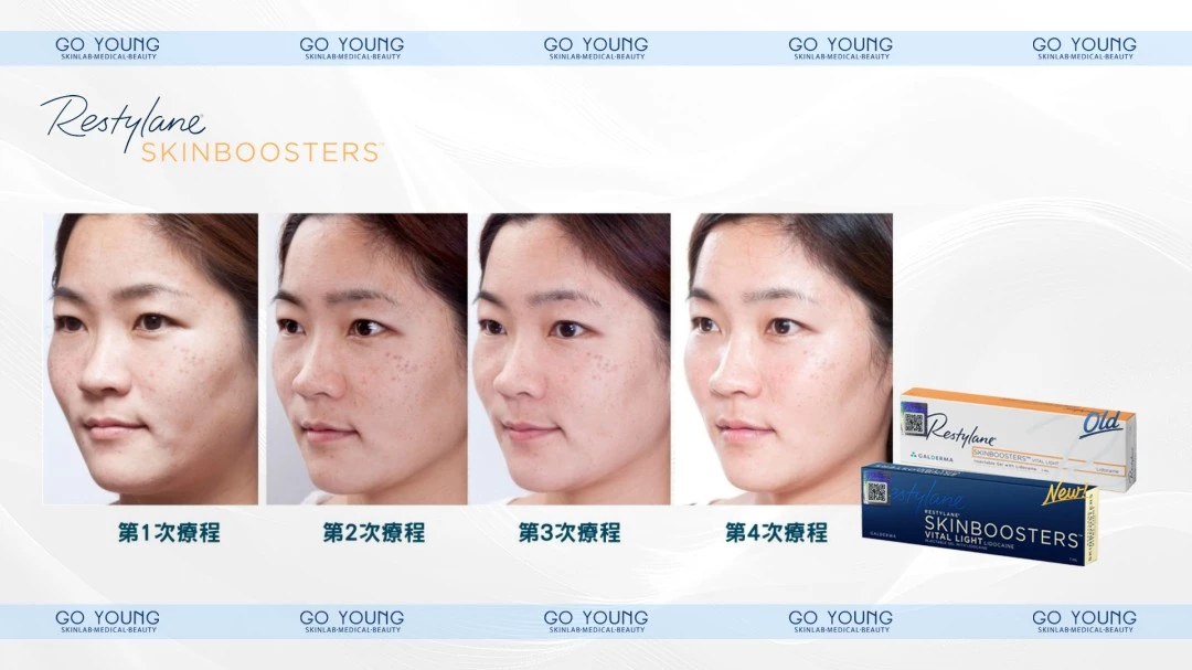 Restylane SKINBOOSTERS Vital Light®高效保濕針