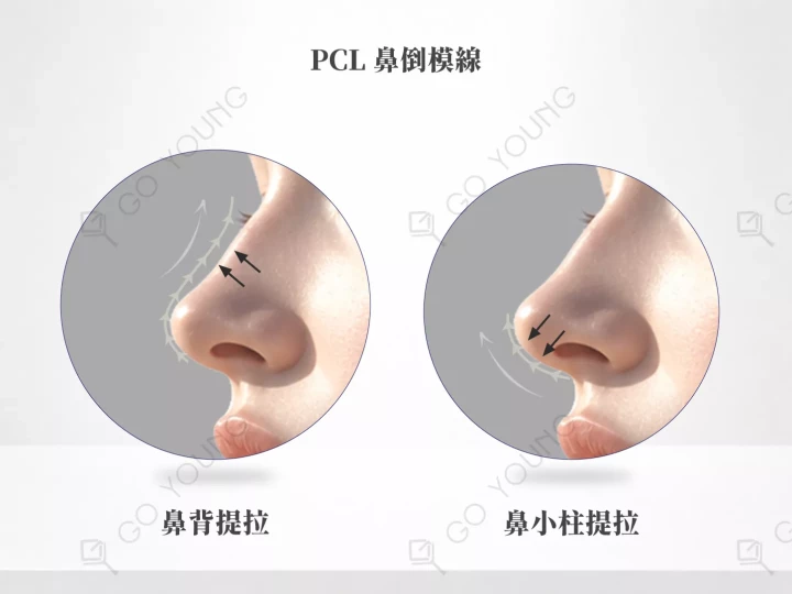 PCL 鼻倒模線