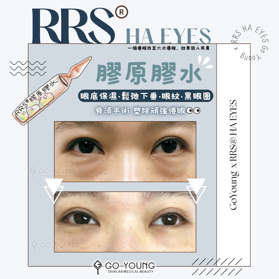 RRS® HA EYES 眼粧針