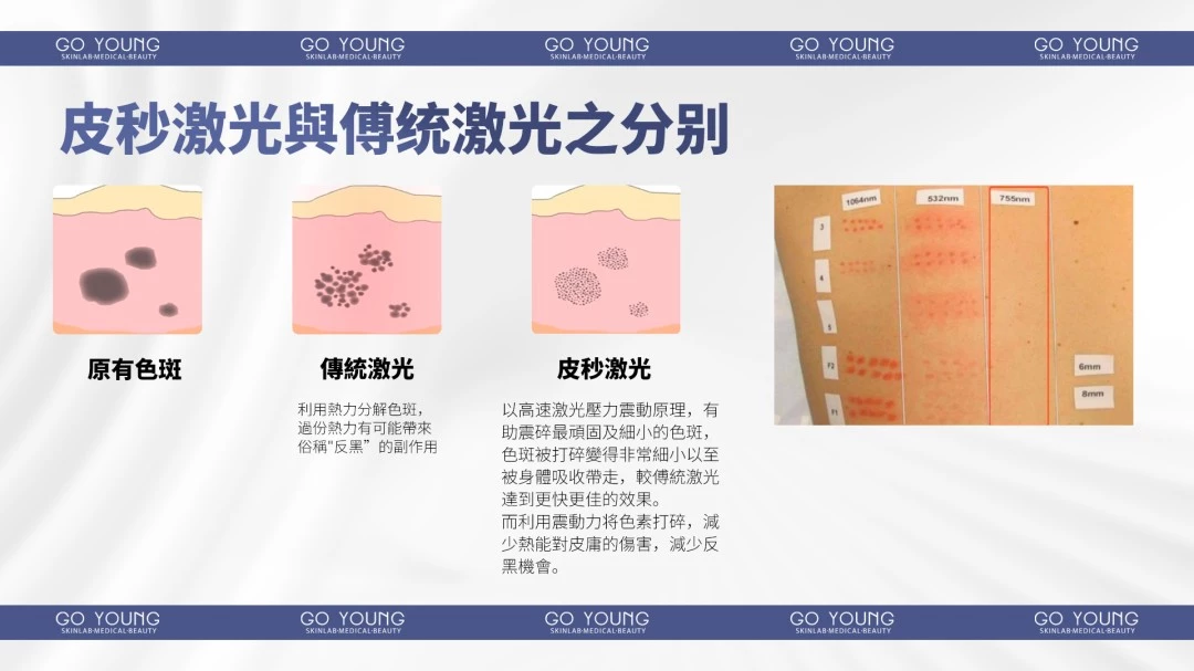 Pico Laser 皮秒雷射療程
