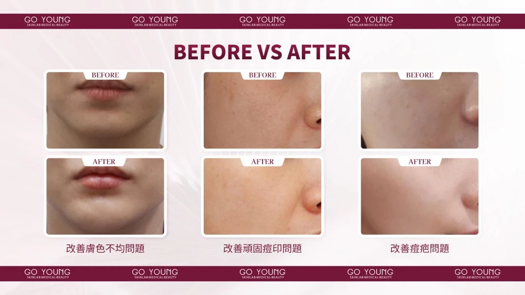 Rejuran® 麗珠蘭HB紅盒
