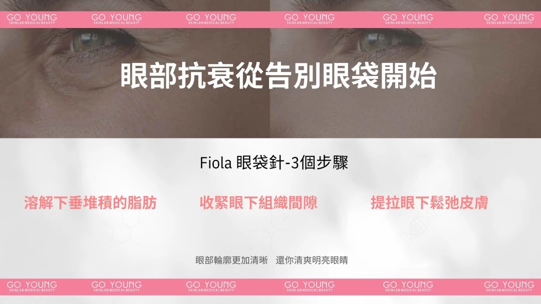 Fiola 眼袋針