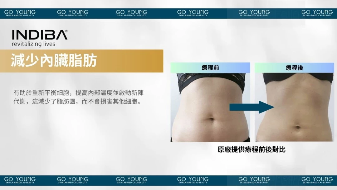 治療師主理|INDIBA® Premium NS