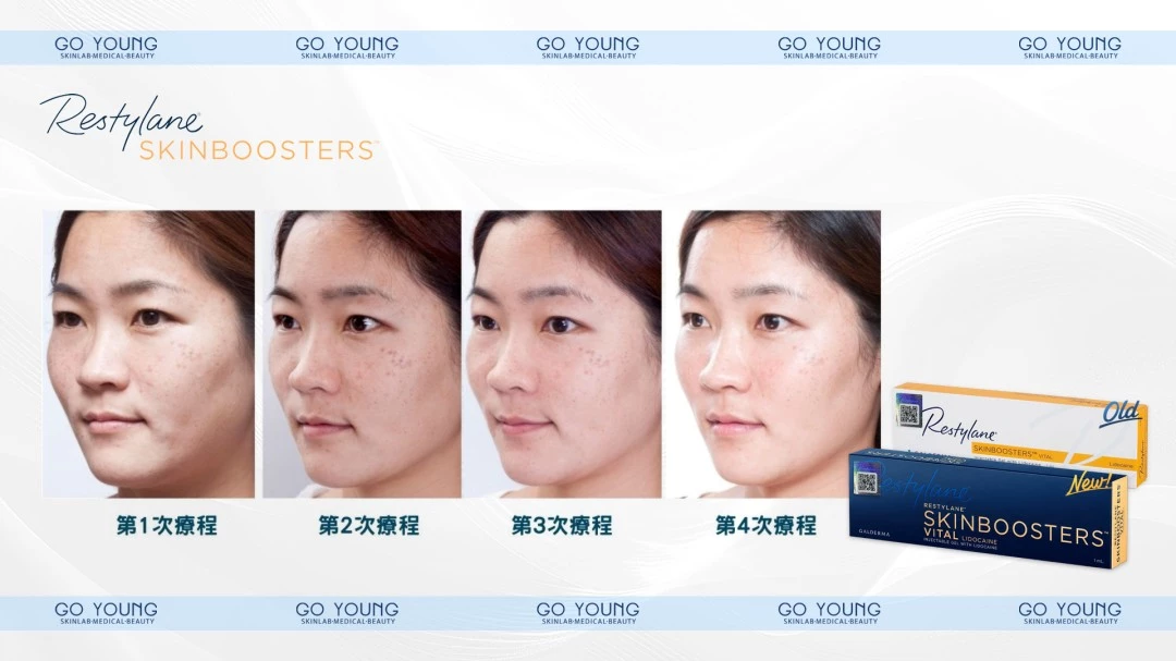 Restylane Skinbooster VITAL