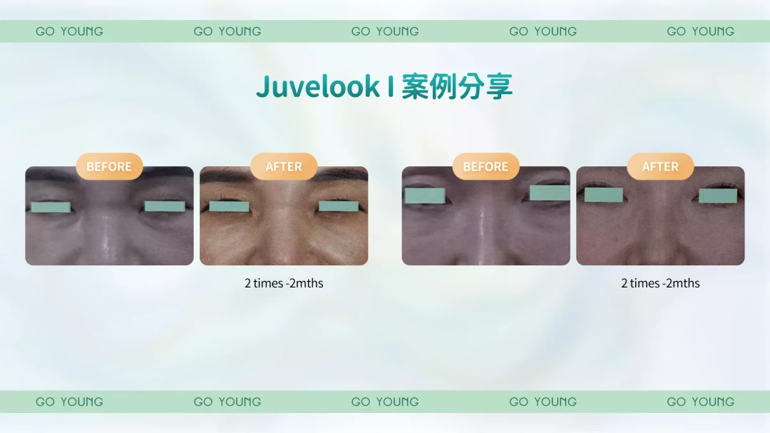 Juvelook I 綠瓶索眼針