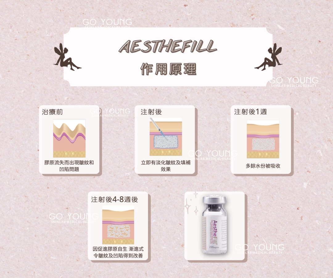 AestheFill 精靈針
