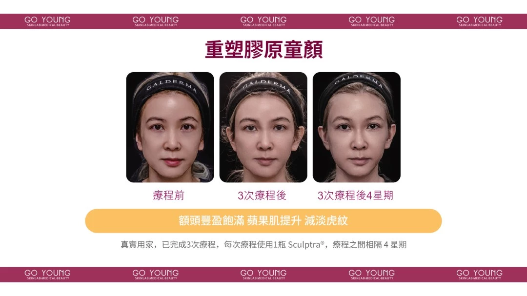 Sculptra 聚左旋乳酸-童顏針