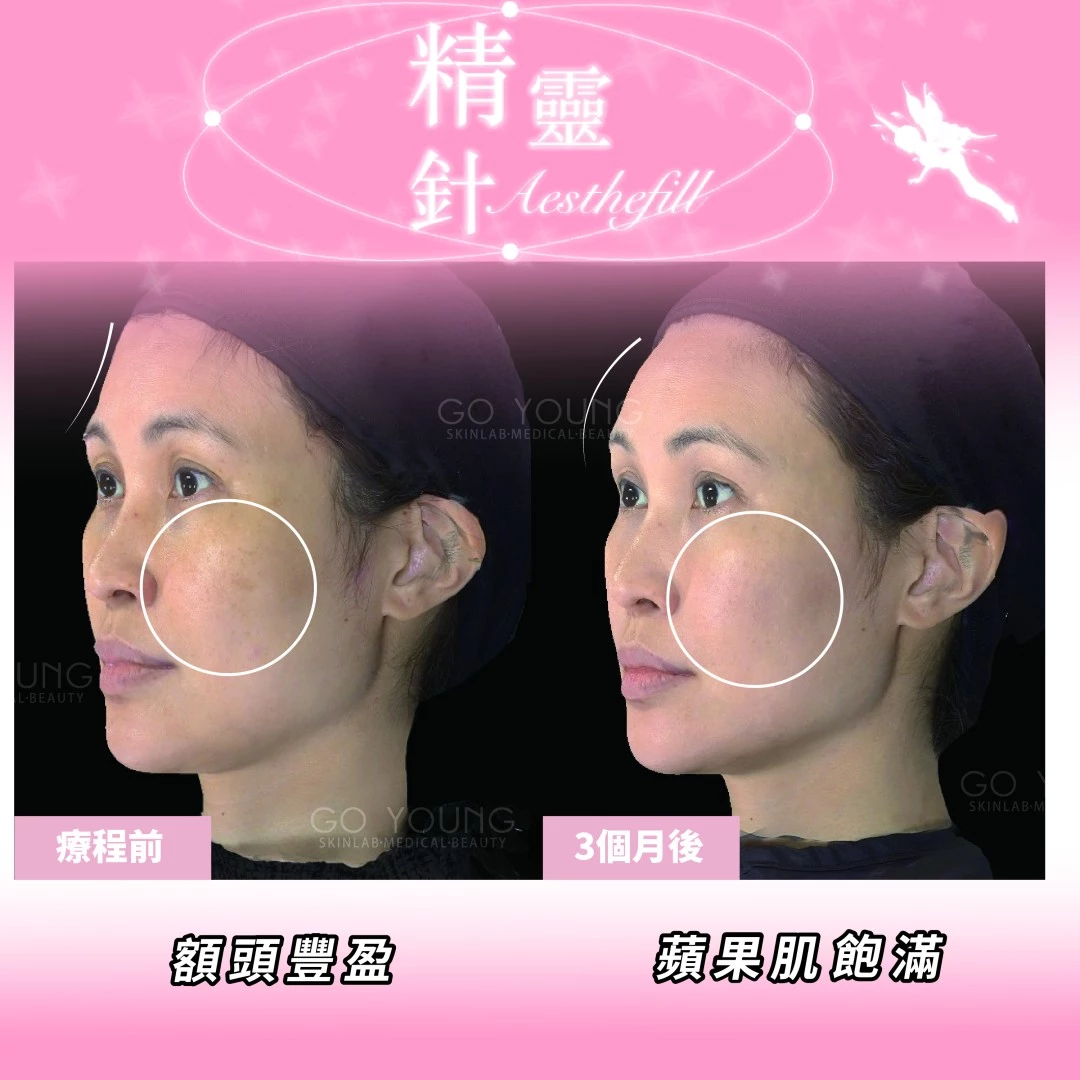 AestheFill 精靈針