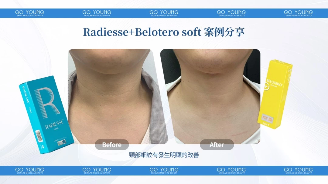 Radiesse 1.5cc + Belotero soft
