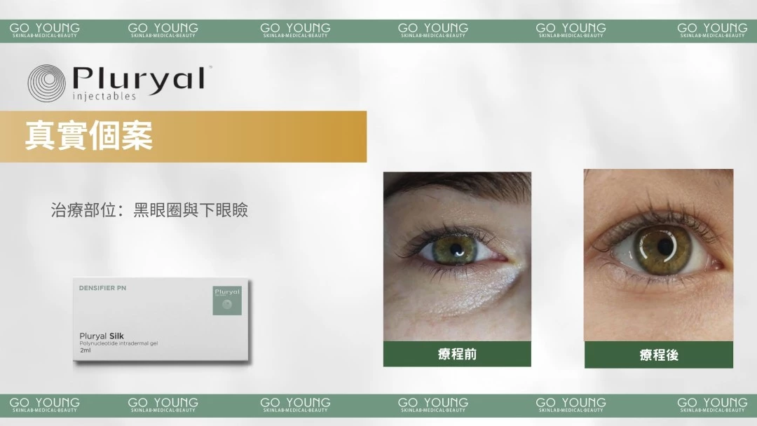 PLURYAL® SILK 濾鏡針-絲柔針