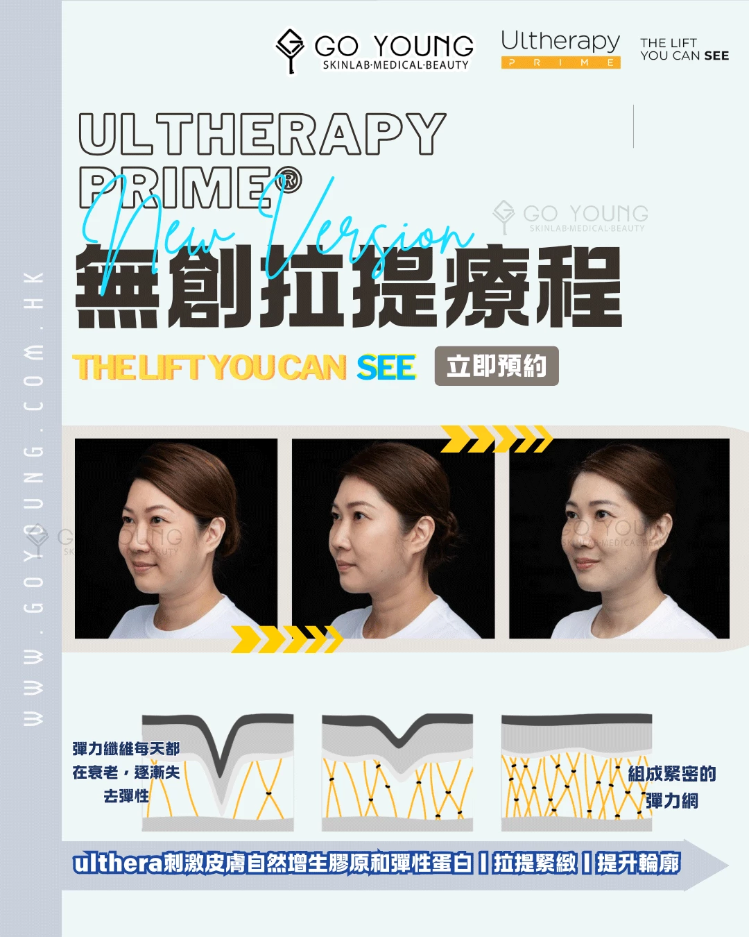 醫生主理 | Ultherapy PRIME® HIFU 二代 超聲刀療程