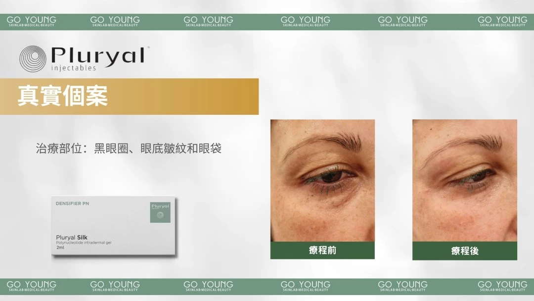 PLURYAL® SILK 濾鏡針-絲柔針