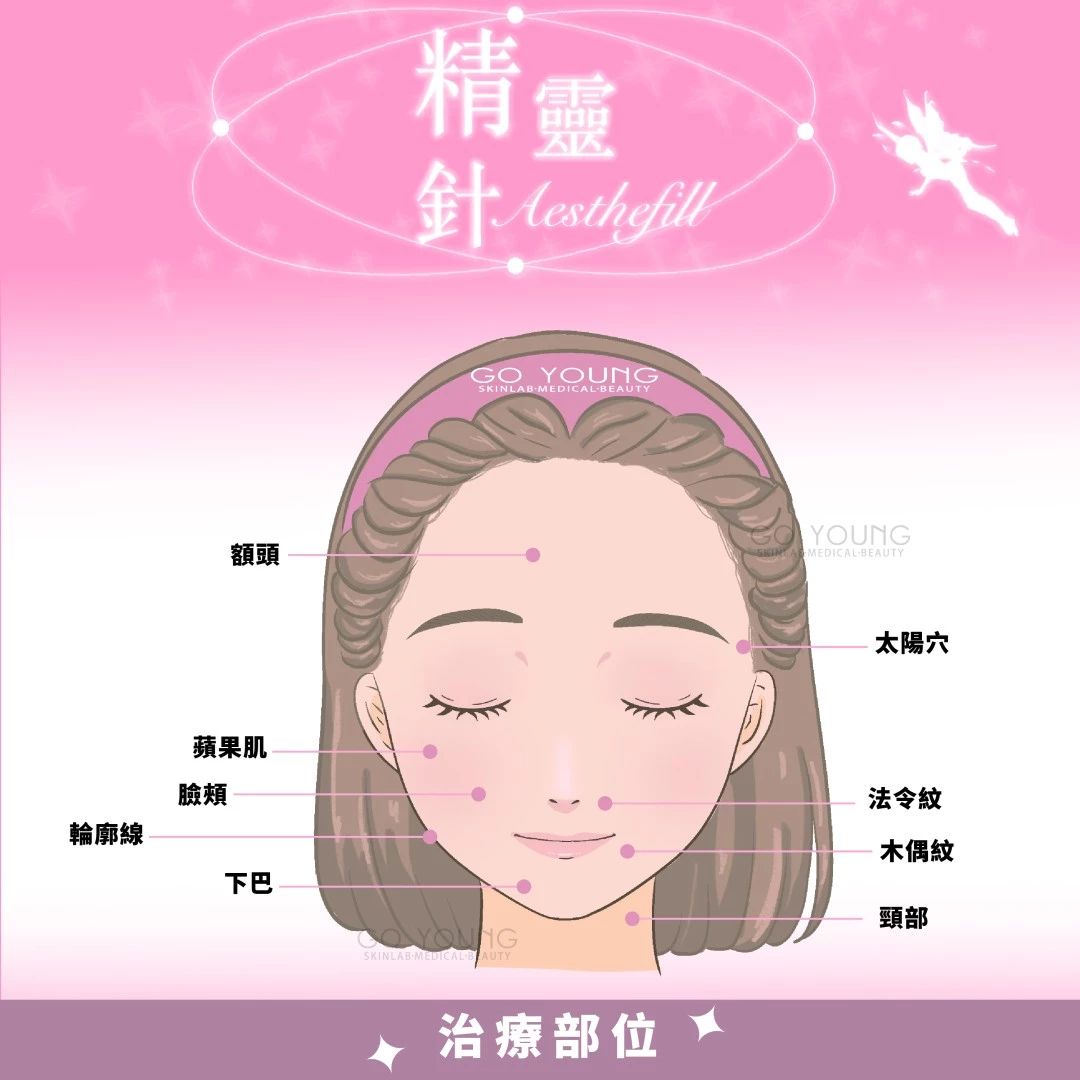 AestheFill 精靈針