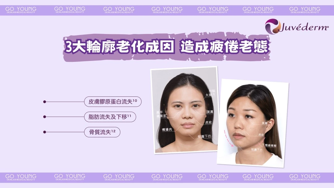JUVÉDERM® VOLIFT（緹顏）