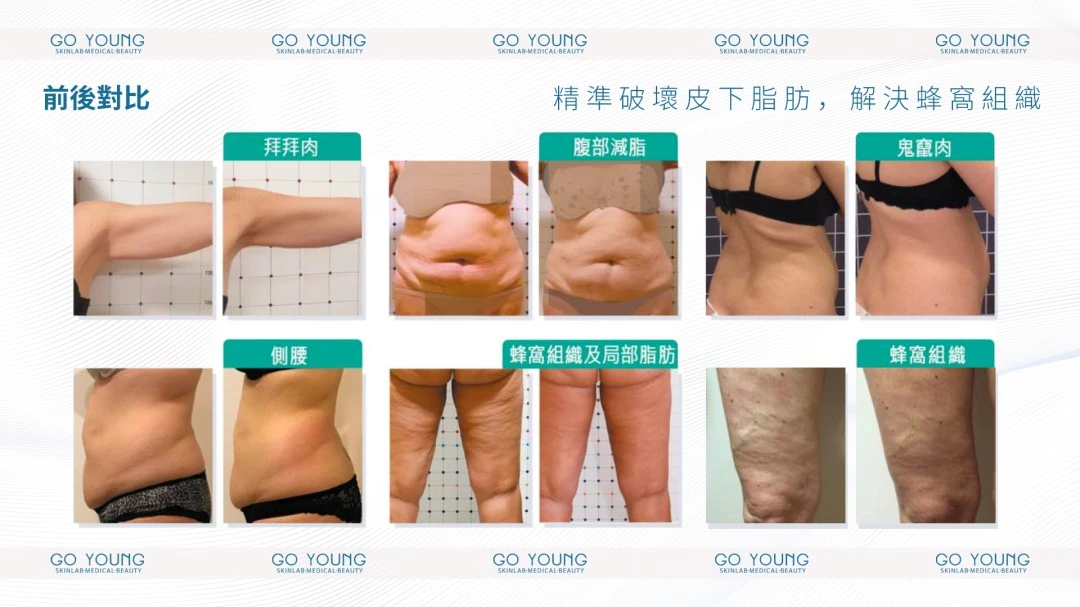 ONDA PRO 一叮溶脂