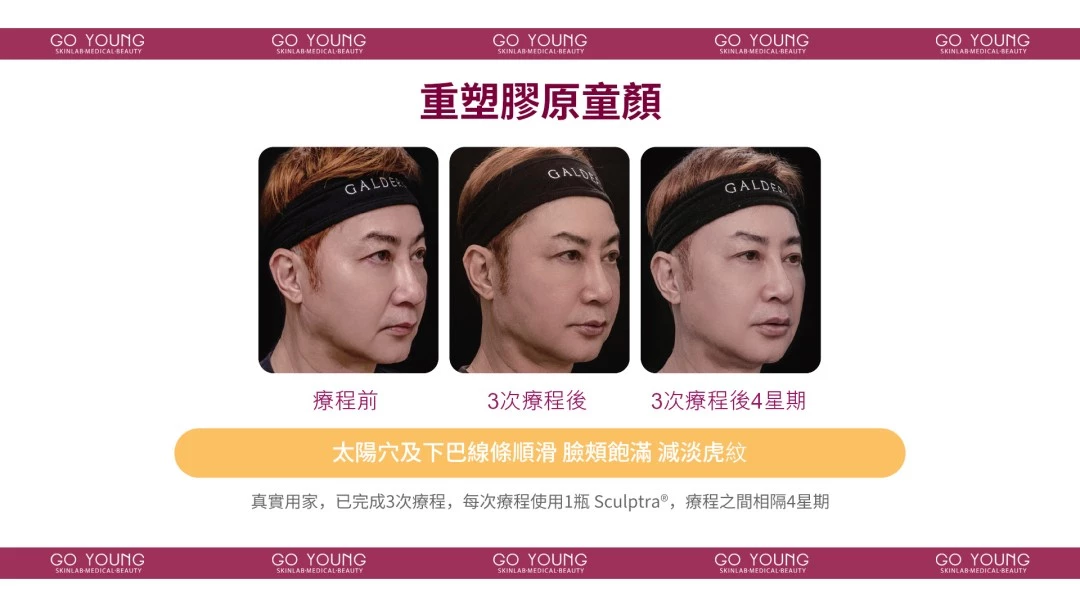 Sculptra 聚左旋乳酸-童顏針