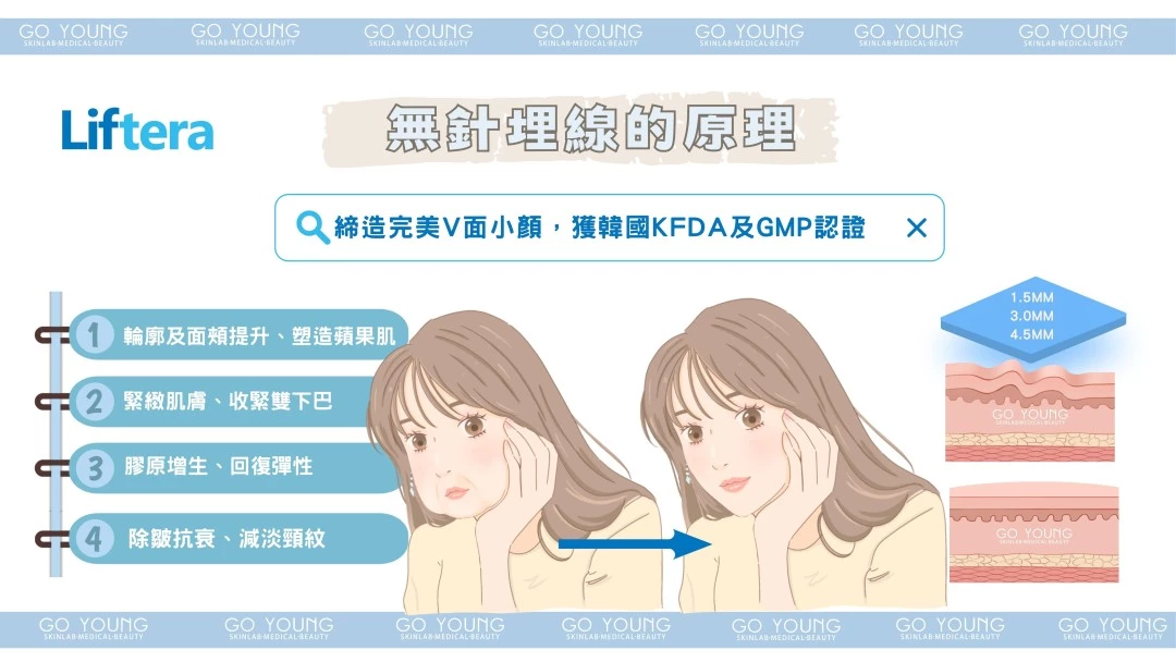 Liftera-V Lift 無針埋線療程