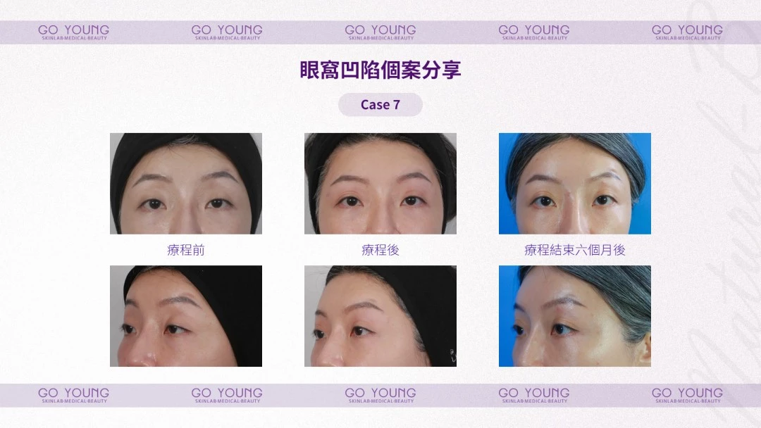 PROSTROLANE Natural B 膠原肽