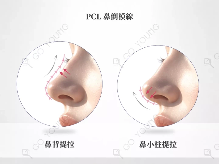 PCL 鼻倒模線
