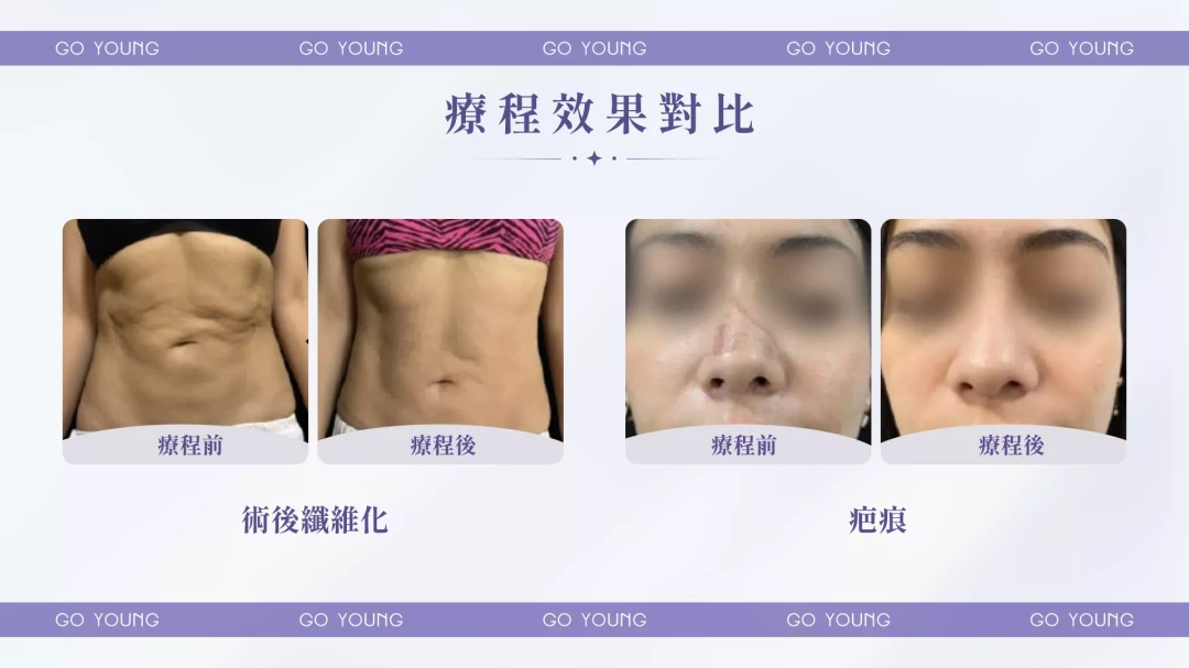 pbserum HA High